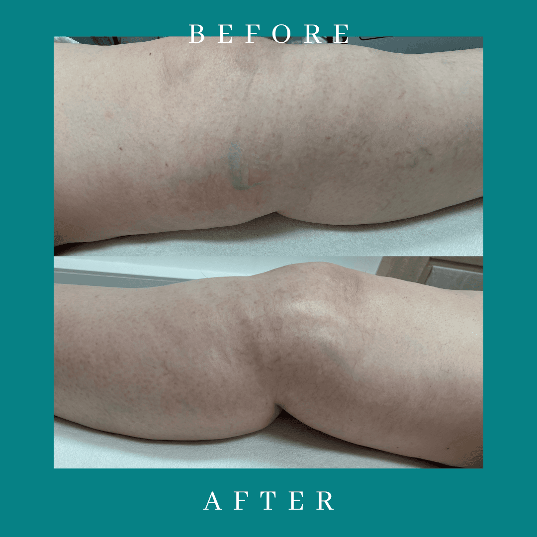 Body Sculpting - Leg Contouring Results Body sculpting leg contouring laser lipo results Hope Island Gold Coast