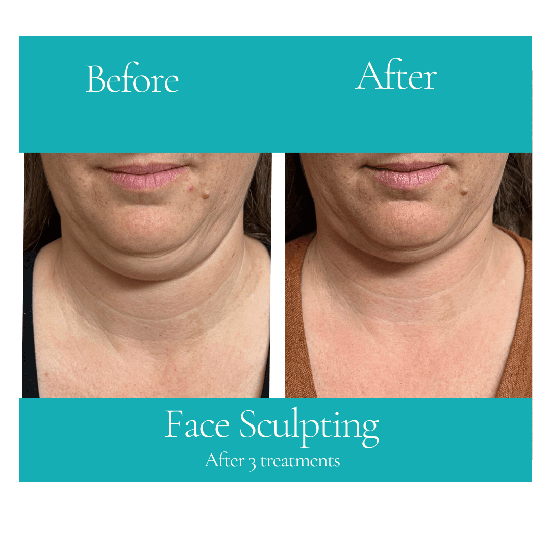 Face Sculpting - Before & After Face sculpting facial contouring treatment before after Helensvale