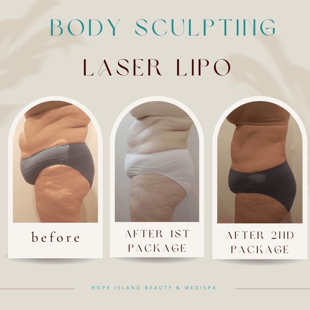 Laser Lipo - Fat Reduction Results Laser lipo fat reduction treatment results Gold Coast medispa
