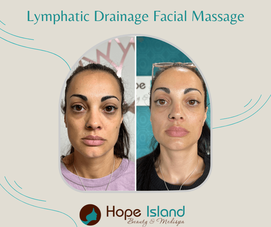 Lymphatic Drainage Facial Massage - Before & After Lymphatic drainage facial massage before after Coomera Sanctuary Cove