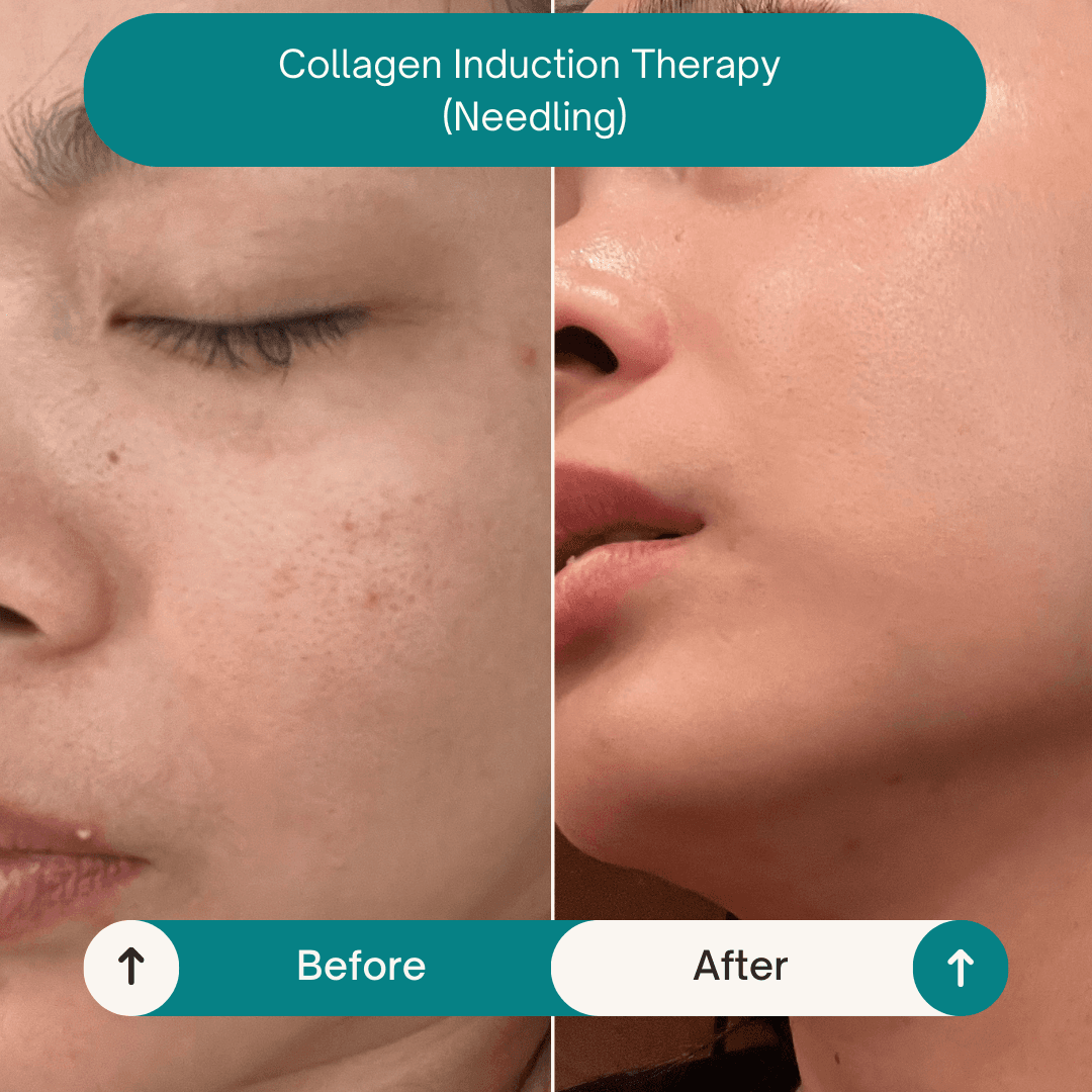 Collagen Induction Therapy - Before & After Collagen induction therapy skin needling before after Hope Island Gold Coast