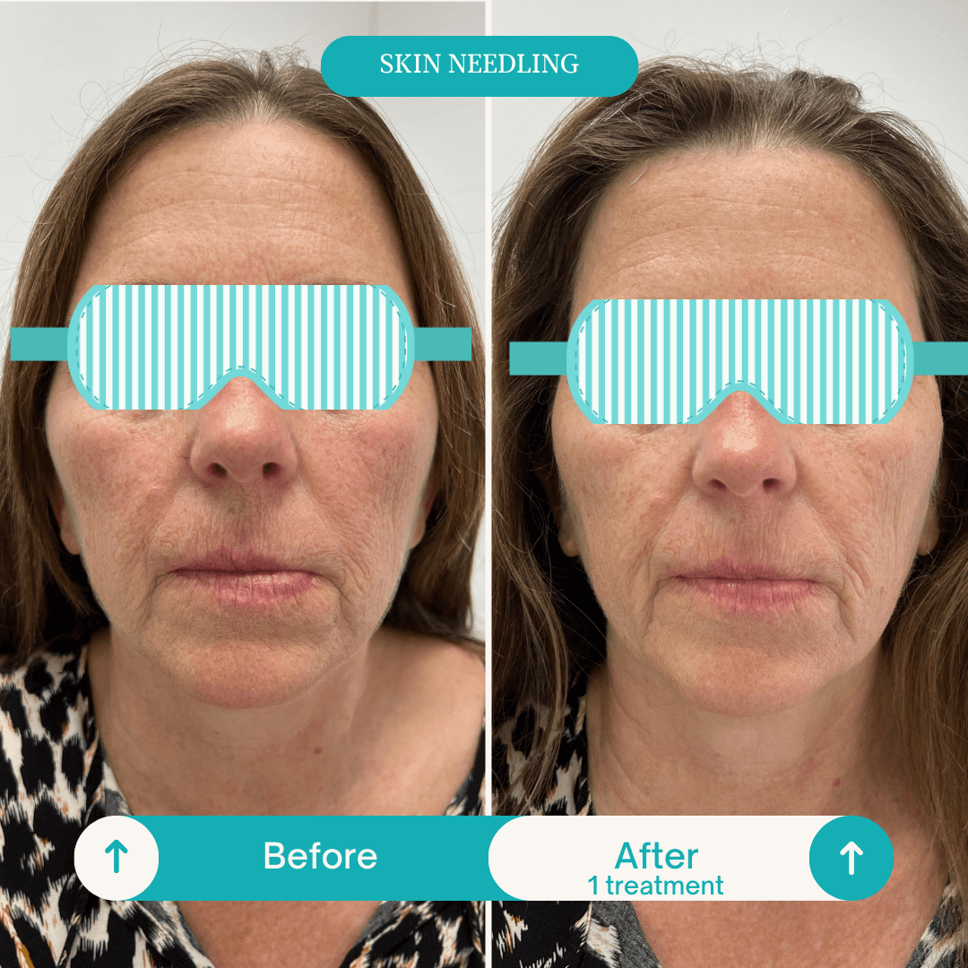 Skin Needling - Before & After Microneedling skin needling treatment results Helensvale Gold Coast medispa