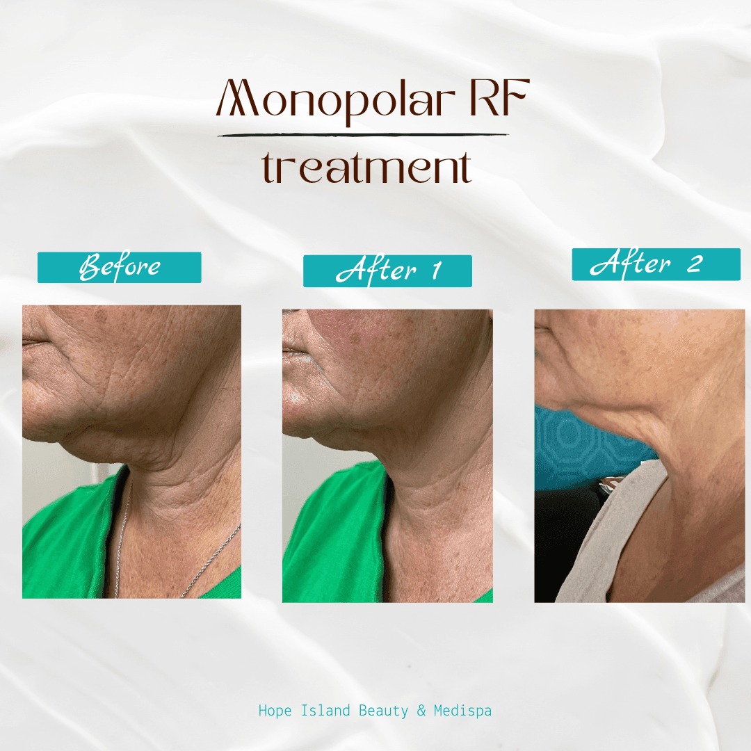 RF Skin Tightening - Chin Area RF skin tightening chin jawline non-surgical face lift Gold Coast Hope Island
