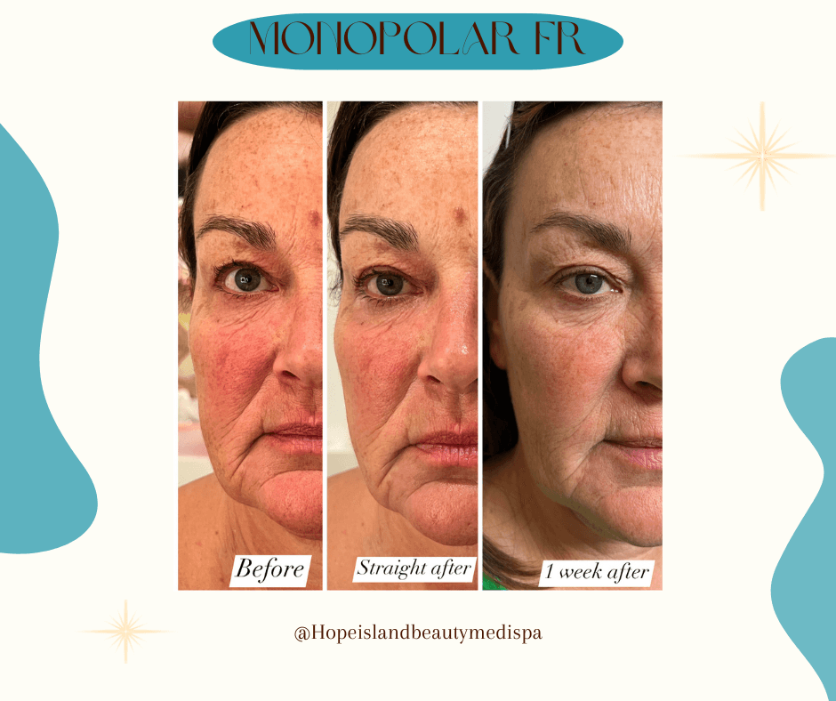 RF Skin Tightening - Full Face Radio frequency facial skin tightening before after Hope Island medispa