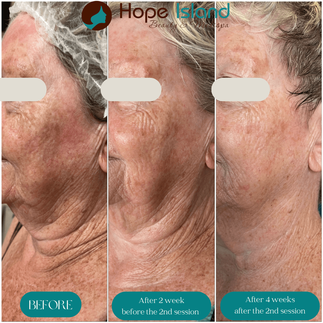 RF Skin Tightening - Neck Area Non-surgical neck lift RF treatment results Helensvale Gold Coast