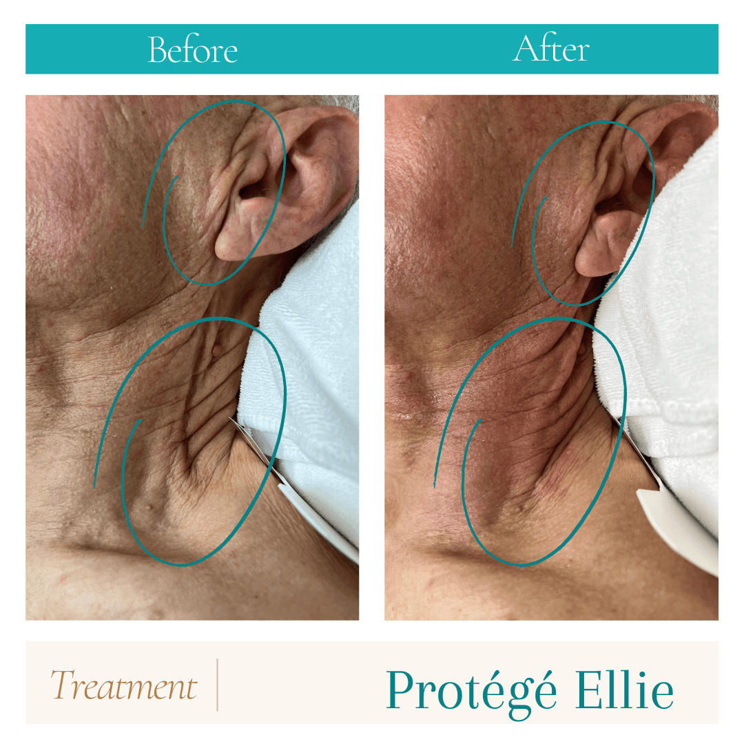 RF Skin Tightening - Neck & Ears RF skin tightening neck ears treatment Coomera Sanctuary Cove area