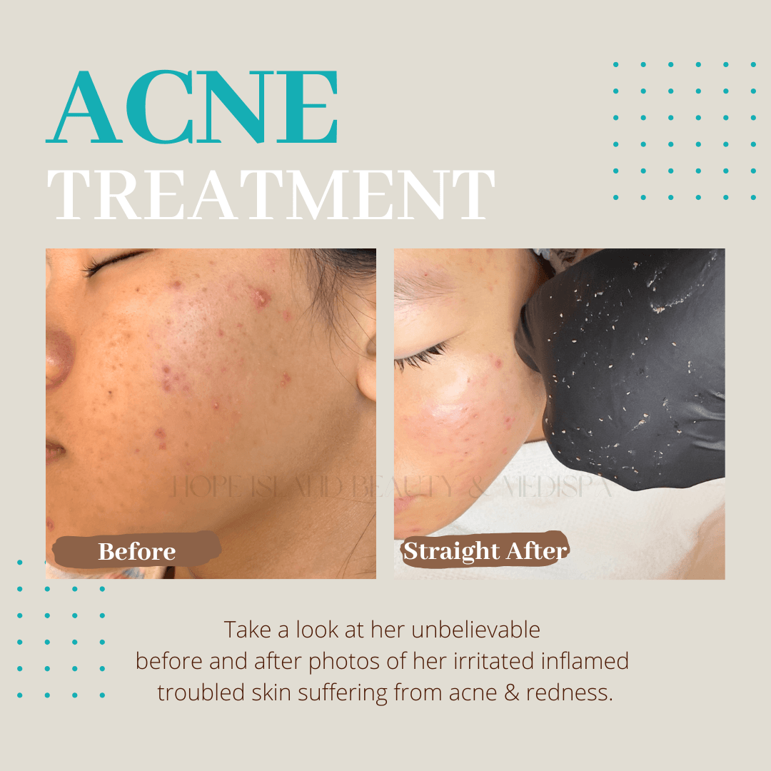 Acne Treatment - Before & After Acne facial treatment before and after results at Hope Island Beauty Medispa Gold Coast