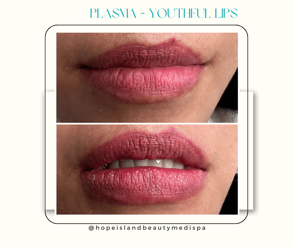 Plasma - Youthful Lips Enhancement Plasma fibroblast lip treatment youthful lips Gold Coast Hope Island