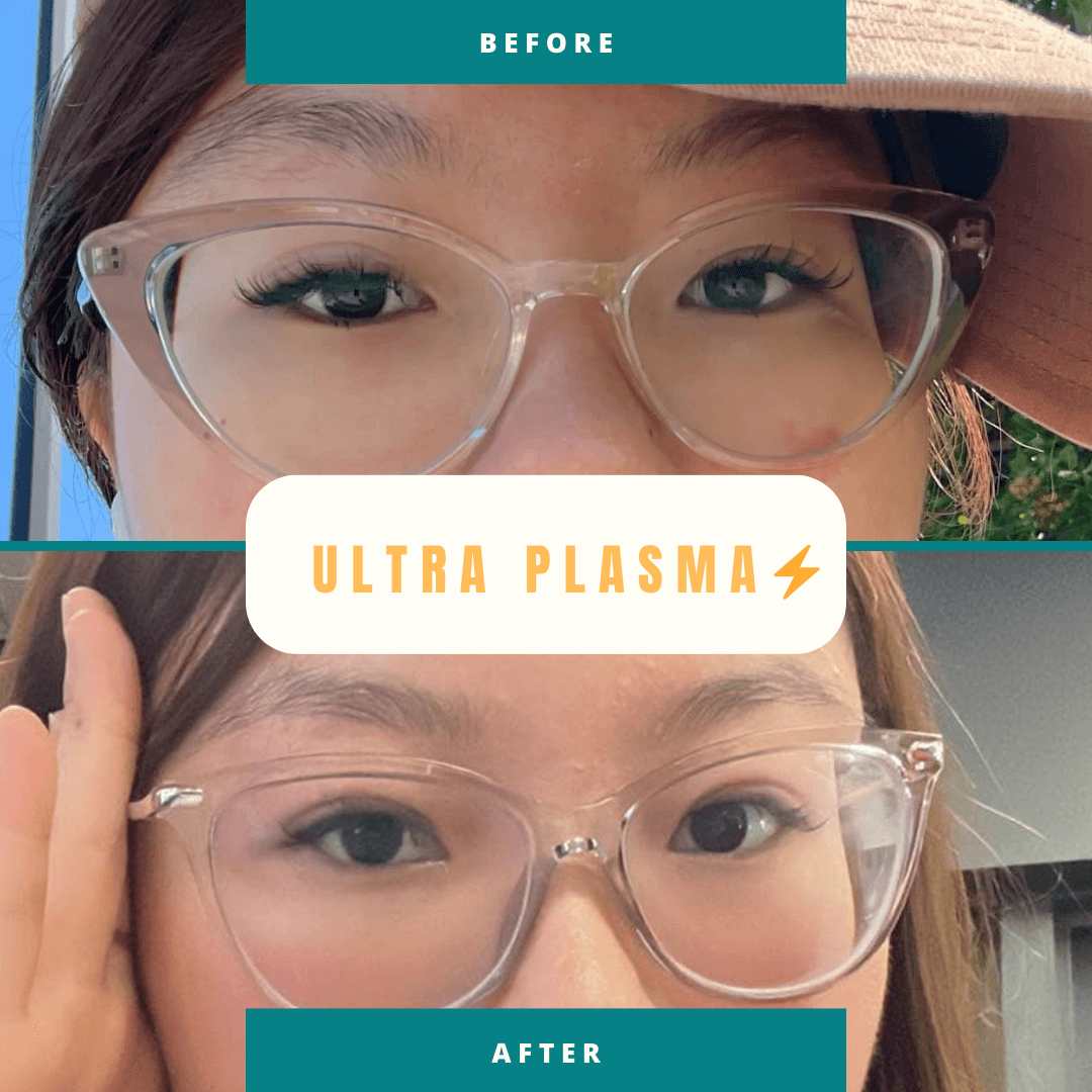 Ultra-Plasma Treatment - Eye Area Before & After Plasma eyelid lift hooded eyes treatment before after Hope Island medispa