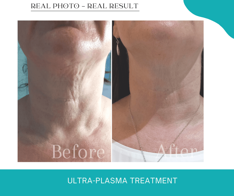 Ultra-Plasma Treatment - Dramatic Results Ultra plasma skin tightening dramatic results Hope Island Beauty Medispa