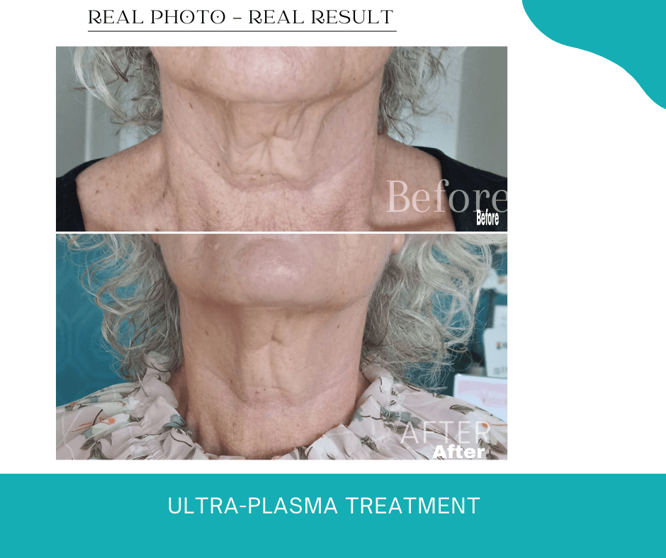 Ultra-Plasma Treatment - Visible Improvement Plasma fibroblast therapy visible improvement Coomera Gold Coast area