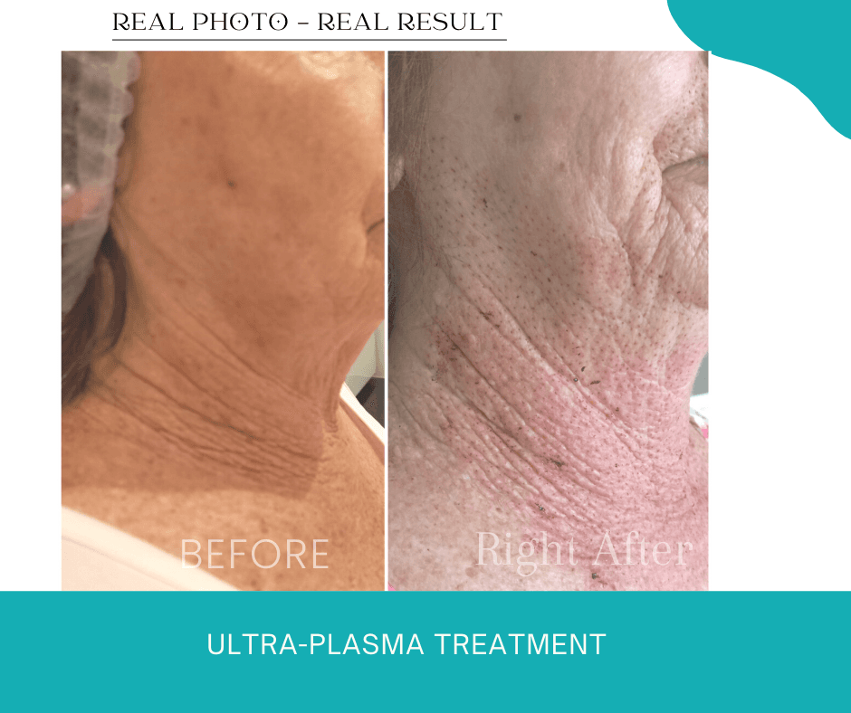 Ultra-Plasma Treatment - Skin Tightening Non-surgical skin tightening plasma treatment Sanctuary Cove Helensvale