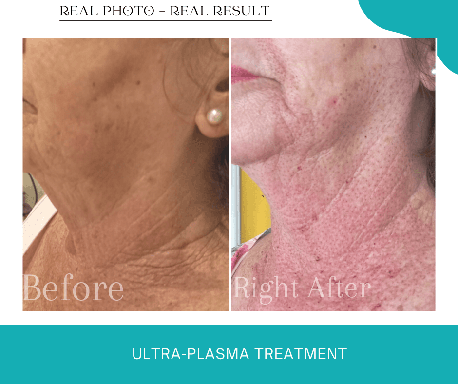 Ultra-Plasma Treatment - Wrinkle Reduction Plasma wrinkle reduction treatment before after Gold Coast medispa