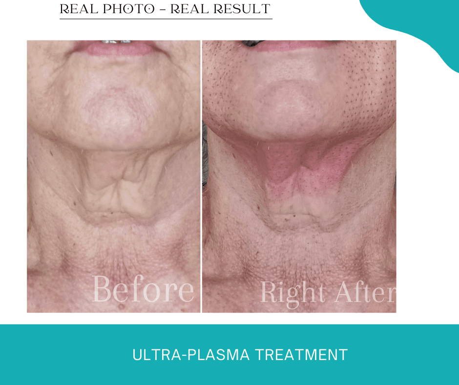 Ultra-Plasma Treatment - Rejuvenation Plasma fibroblast skin rejuvenation Hope Island Beauty Medispa results