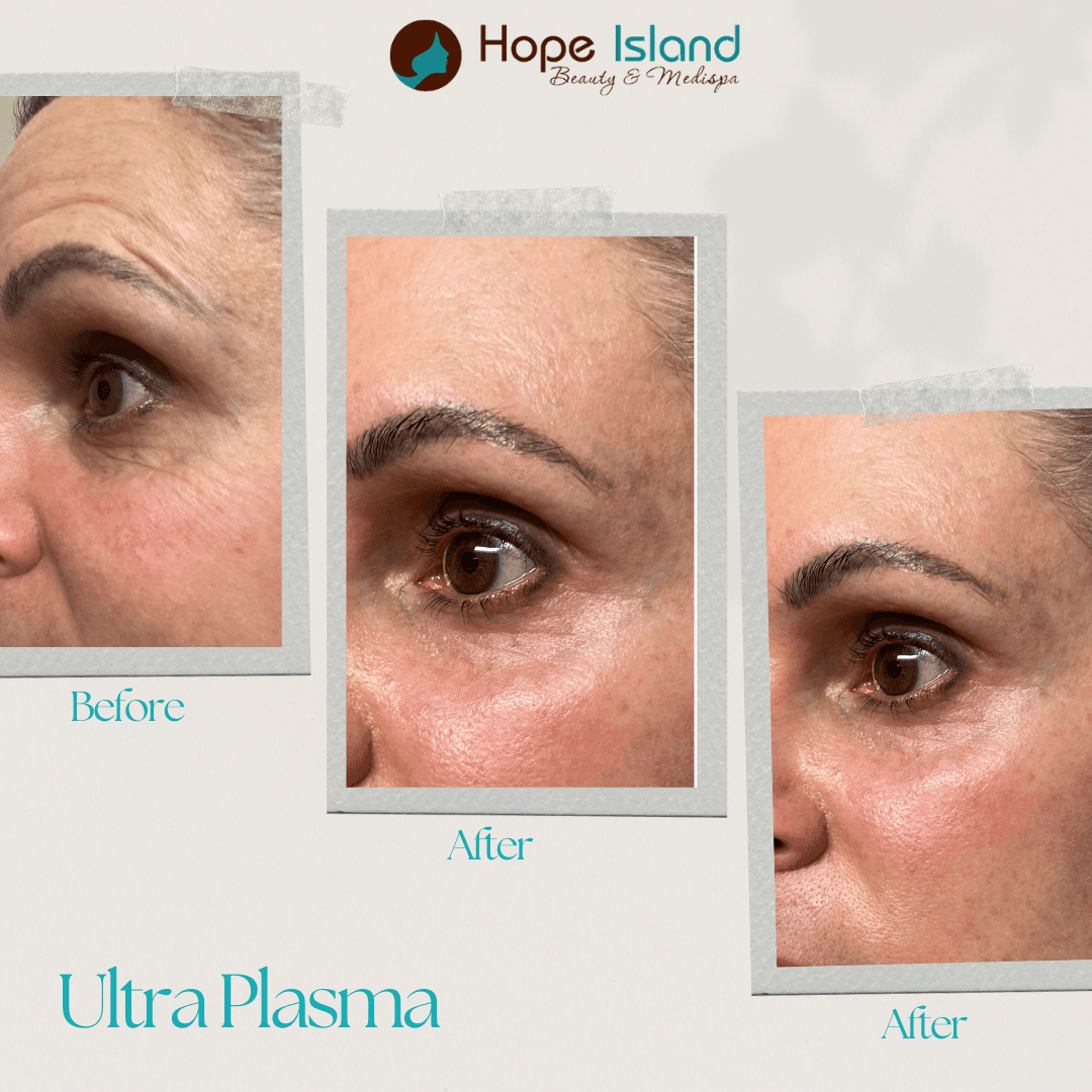 Ultra-Plasma Treatment - Full Face Before & After Plasma fibroblast face skin tightening Gold Coast Helensvale results
