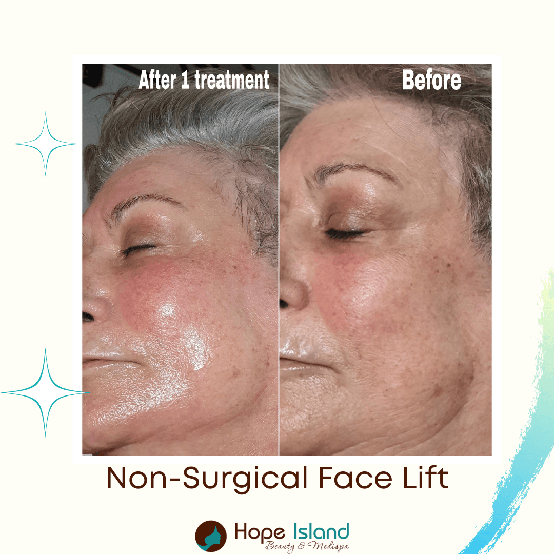 RF Skin Tightening at Hope Island Beauty & Medispa