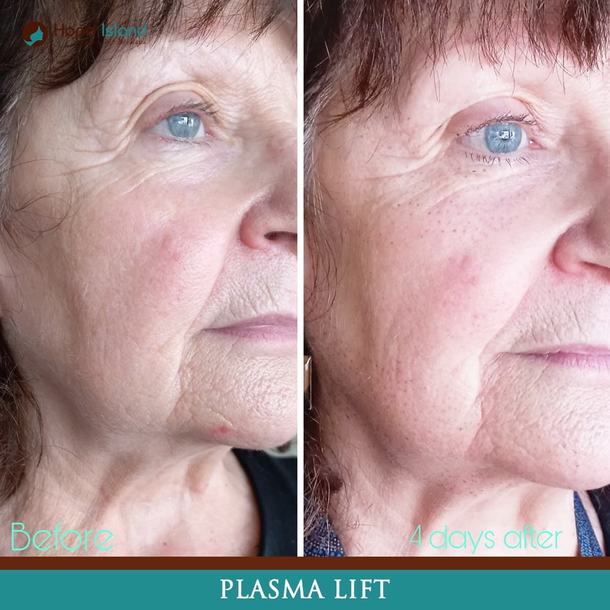 Ultra-Plasma fibroblast treatment result at Hope Island Beauty & Medispa