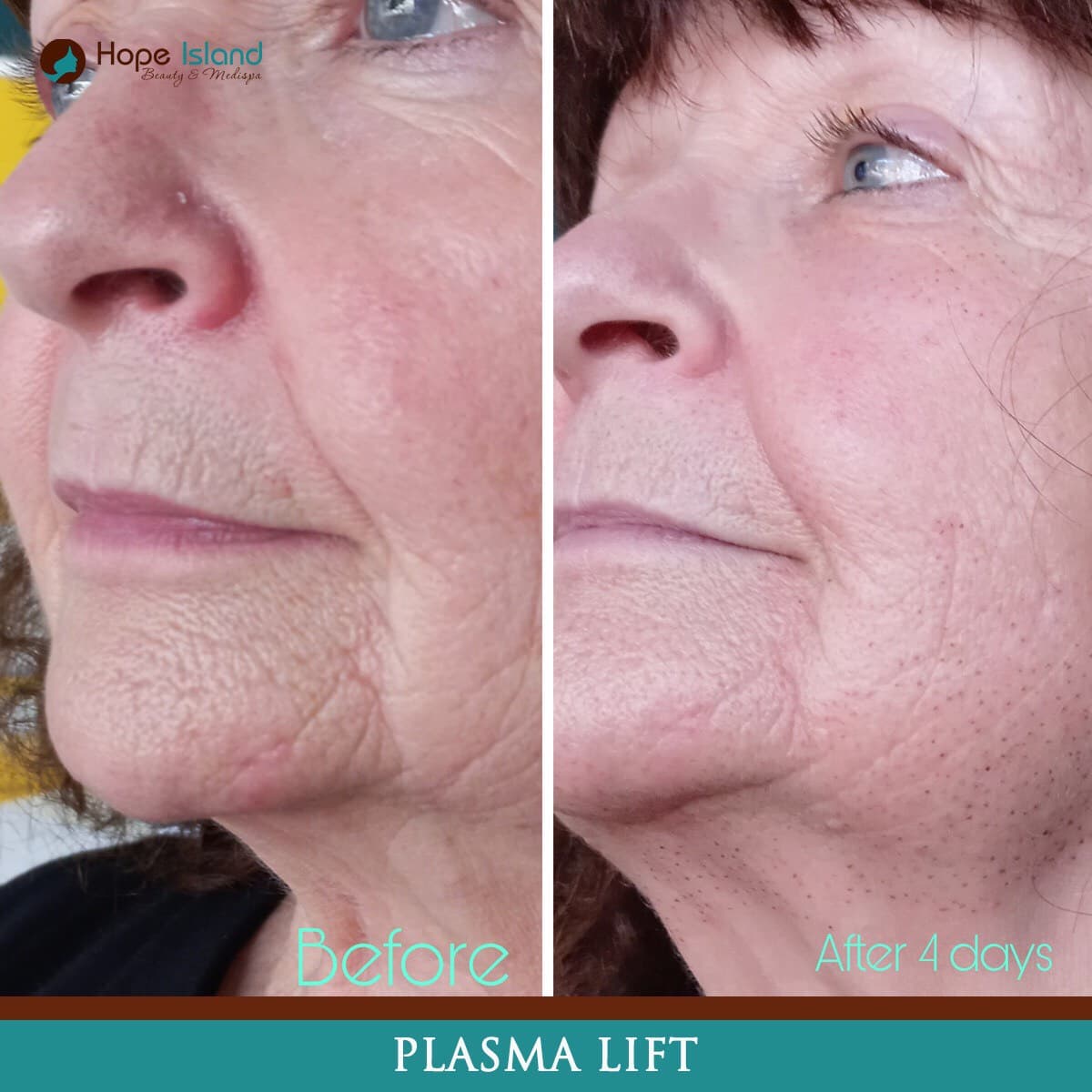 Ultra-Plasma fibroblast treatment result at Hope Island Beauty & Medispa