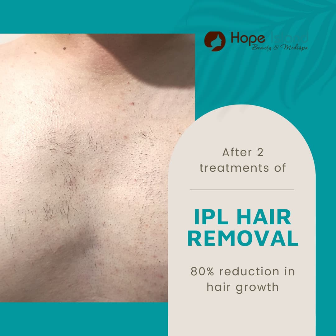 Treatment result at Hope Island Beauty & Medispa