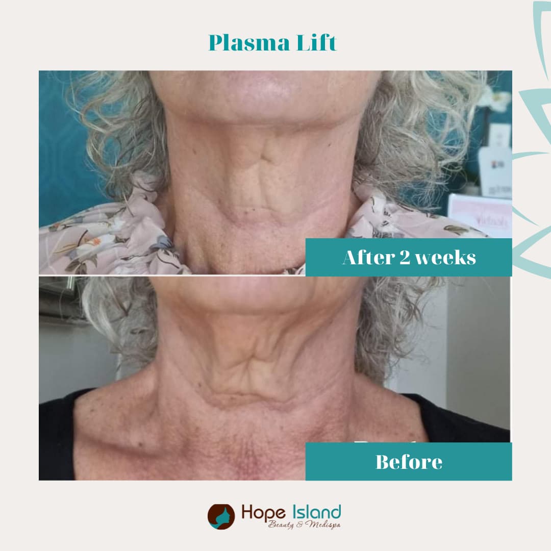 Treatment result at Hope Island Beauty & Medispa
